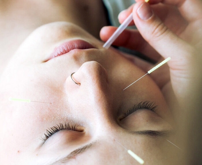 ACUPUNTURA COSMETICA