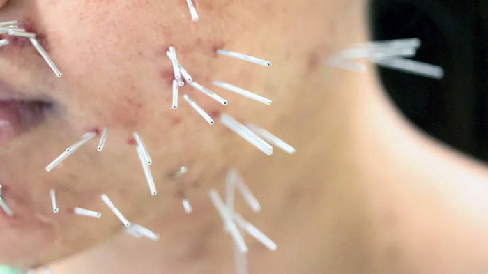 ACUPUNTURA COSMETICA