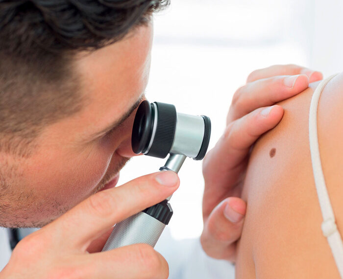 Qué es el cáncer de piel