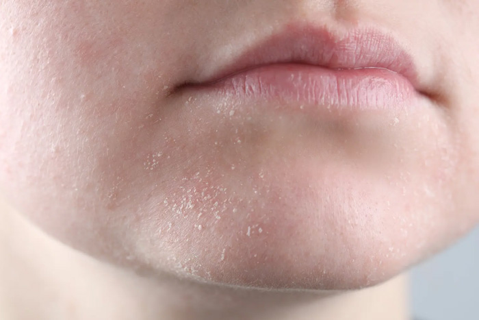 DERMATITIS ATOPICA