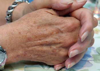 Léntigos seniles, solares, benignos y malignos