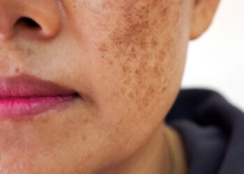 MELASMA Y LENTIGO