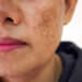 MELASMA Y LENTIGO