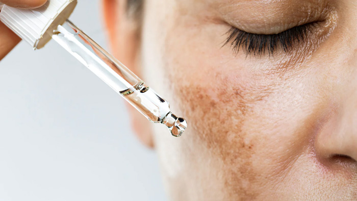 MELASMA Y LENTIGO