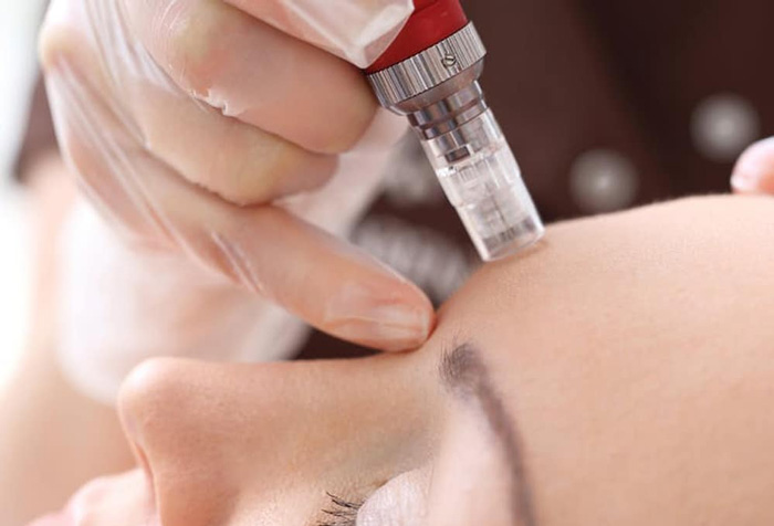 MELASMA Y LENTIGO