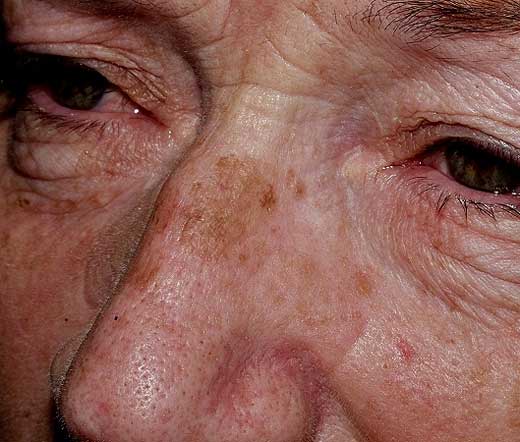 MELASMA Y LENTIGO