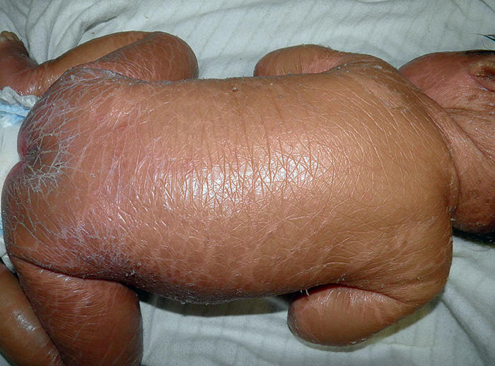 PIEL DE MARIPOSA