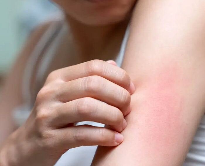 Prurito, el deseo de rascarse