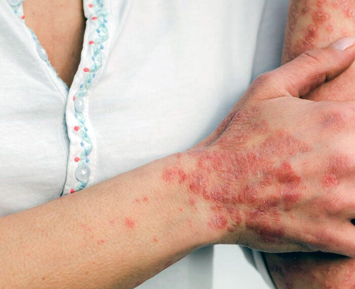PSORIASIS