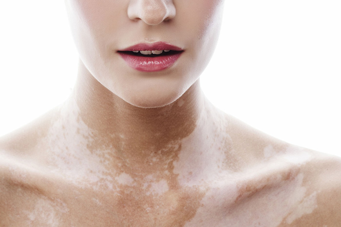 VITILIGO