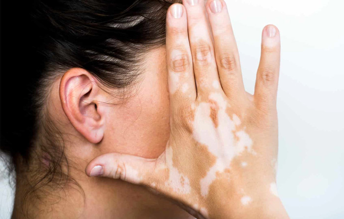 VITILIGO