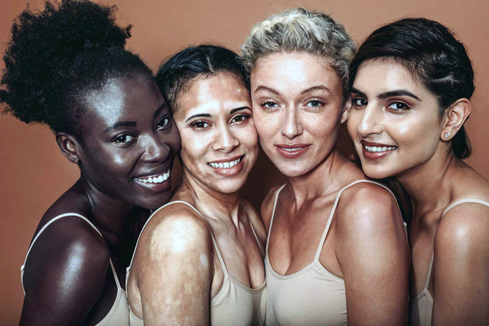 VITILIGO