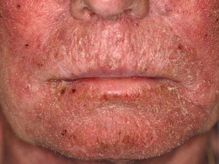 XEROSIS
