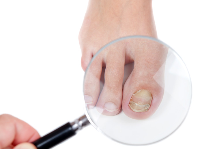 Descamación, estrías, micosis... las diferentes afecciones de las uñas