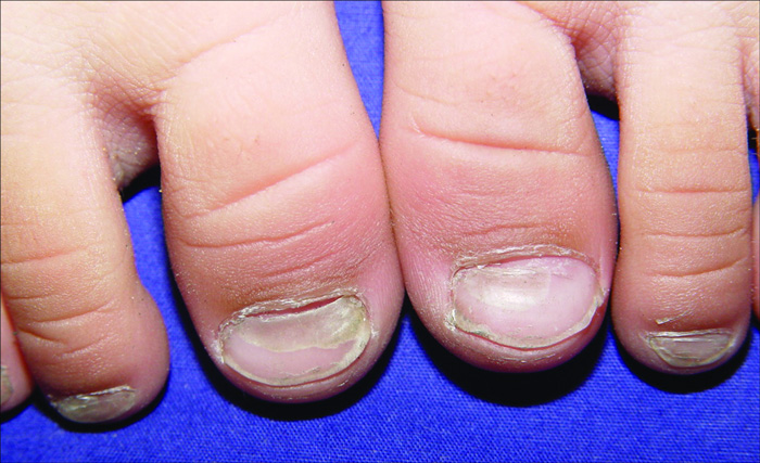 11 problemas habituales de las uñas